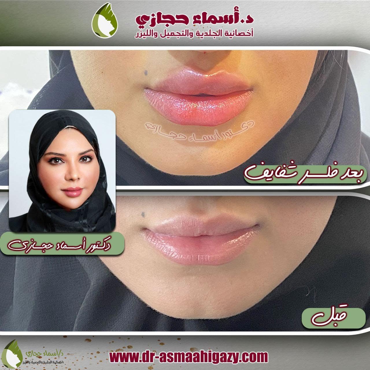 Whatsapp Image 2022 07 13 At 11.07.45 Am 1 | الموقع الالكتروني للدكتورة اسماء حجازي عملية نفخ الشفايف