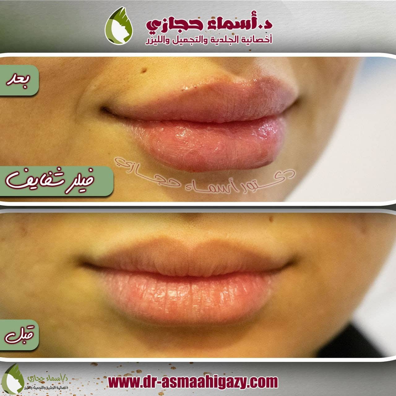 Whatsapp Image 2022 07 13 At 11.07.45 Am | الموقع الالكتروني للدكتورة اسماء حجازي عملية نفخ الشفايف