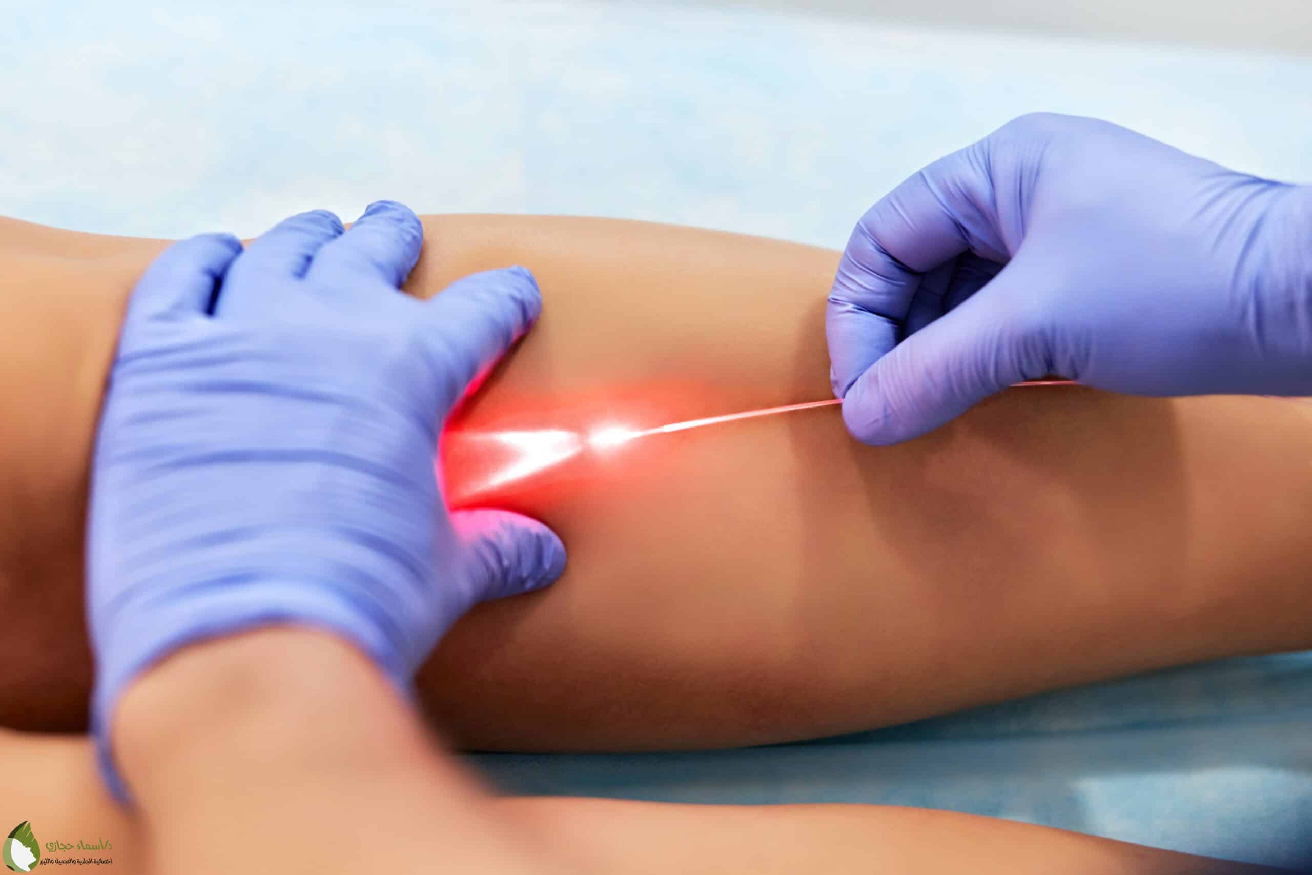 Laser Services 23 Scaled | الموقع الالكتروني للدكتورة اسماء حجازي خدمات الليزر