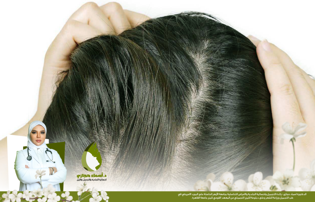علاج تساقط الشعر نهائيا