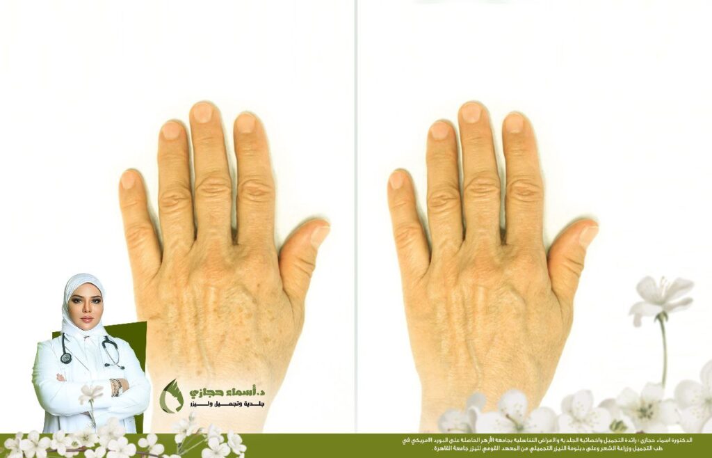 Photo ٢٠٢٥ ٠١ ٠٨ ٠٢ ٠٧ ٥٥ | الموقع الالكتروني للدكتورة اسماء حجازي التقشير الكربوني لليدين