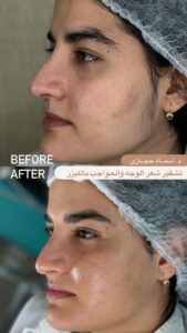 Img 20240120 032134 584 | الموقع الالكتروني للدكتورة اسماء حجازي تشقير الشعر بالليزر