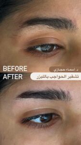 Img 20240120 032212 650 | الموقع الالكتروني للدكتورة اسماء حجازي تشقير الشعر بالليزر