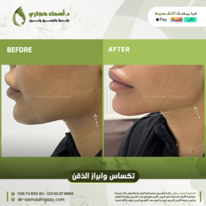 Jo 7 Dec 23 Before After 11 1 | الموقع الالكتروني للدكتورة اسماء حجازي فيلر الوجه