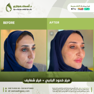 Jo 7 Dec 23 Before After 6 1 | الموقع الالكتروني للدكتورة اسماء حجازي فيلر الوجه