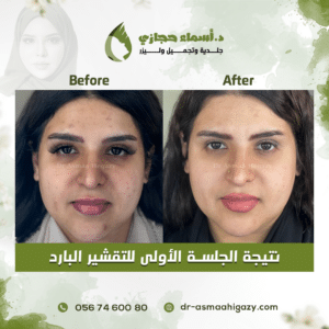 تعليمات بعد التقشير البارد