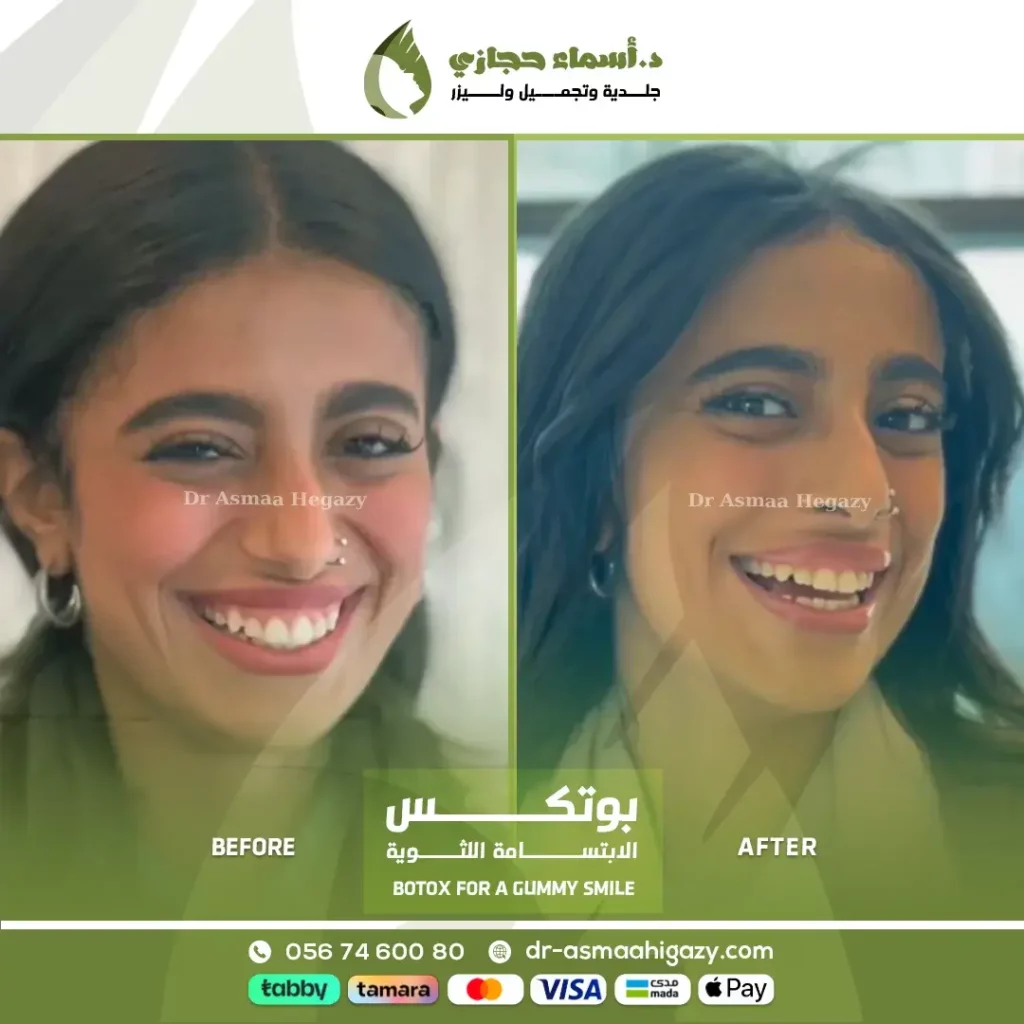 3Grd 24 Aug 13 Ba Botox Store19 | الموقع الالكتروني للدكتورة اسماء حجازي علاج الأبتسامة اللثوية