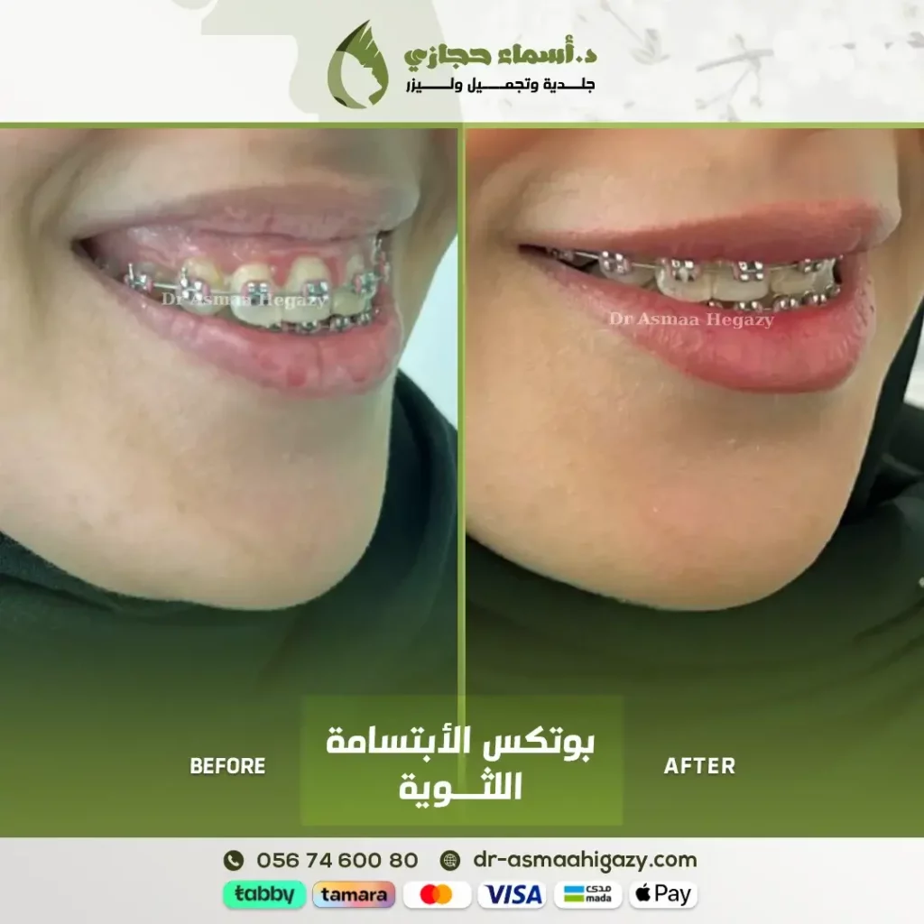 Jo 24 Sep 19 Ba 5 | الموقع الالكتروني للدكتورة اسماء حجازي علاج الأبتسامة اللثوية