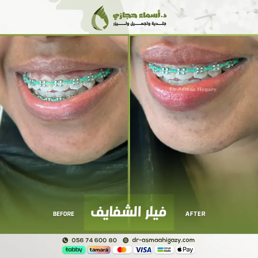 Jo 24 Sep 19 Ba 8 | الموقع الالكتروني للدكتورة اسماء حجازي علاج الأبتسامة اللثوية