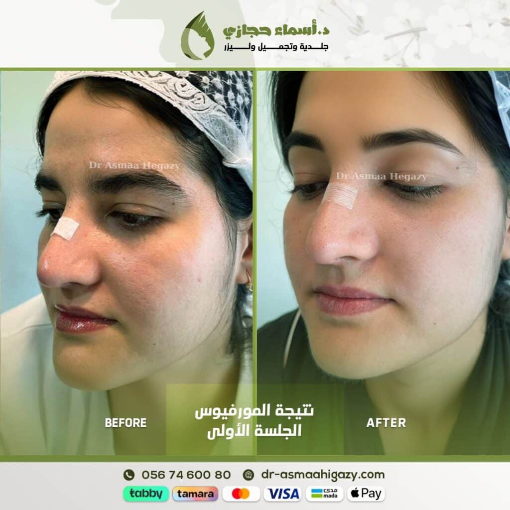Photo ٢٠٢٥ ٠١ ٠٥ ١٠ ١٠ ٣٠ | الموقع الالكتروني للدكتورة اسماء حجازي جلسة مورفيوس لعلاج وتقفيل المسامات