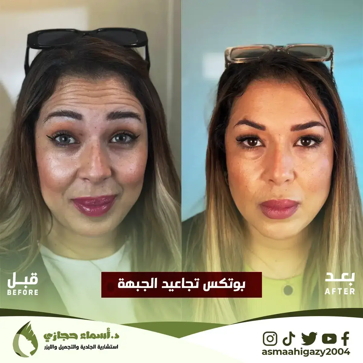 متى تبان نتيجة البوتكس